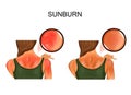 Sunburn skin. tan on the girls back Royalty Free Stock Photo
