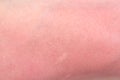 Sunburn skin