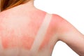 Sunburn. Woman got a Sunburn. Red painful skin on back that feels hot to the touch after beach visits. Use Sunscreen