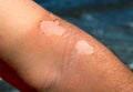 Sunburned male arm with peel on marine background. Sun burned female hand. Tropical seaside danger