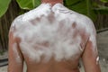 Sunburned man with cooling foam on her back. Man got sunburn and tan on her shoulder. Skin care concept Royalty Free Stock Photo
