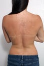 Sunburned, Peeling Female (1) Royalty Free Stock Photo