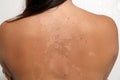 Sunburned, Peeling Female (3) Royalty Free Stock Photo