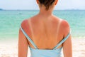 Sunburned skin on shoulder and back of a woman. Red skin sun burn after Sunbathing at the beach. Summer and holiday concept