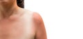 Sunburned skin on shoulder and chest of a woman. Red skin sun burn after Sunbathing at the beach Royalty Free Stock Photo