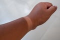 Sunburnt Arm Royalty Free Stock Photo