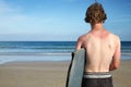 The sunburnt surfer. Royalty Free Stock Photo