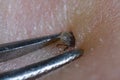 Super close up of sucking tick Ixodes ricinus removal with steel tweezers on human skin Royalty Free Stock Photo