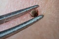 Super close up of sucking tick Ixodes ricinus removal with steel tweezers on human skin Royalty Free Stock Photo