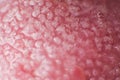 Super macro surface of tongue candidiasis overgrowth