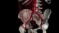 The superficial epigastric artery is a small branch of the femoral artery