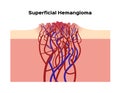 Superficial hemangioma / organ and anatomy Royalty Free Stock Photo