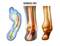 Supinated foot, arch deformation, bottom and back view . Foot weight distribution.