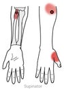 Managing hand and thumb pain arriving from a myofascial trigger point in the Supinator muscle