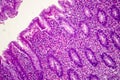 Suppurative appendicitis, light micrograph Royalty Free Stock Photo