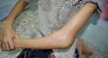 Supracondylar fracture or broken elbow in Asian child. Fracture of distal humerus bone close to elbow. Caused by a fall on