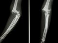 Supracondylar humerus fracture