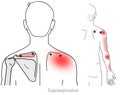 Supraspinatus: Managing shoulder and arm pain arriving from myofascial trigger points in the Supraspinatus muscle Royalty Free Stock Photo