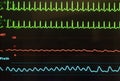 Supraventricular Tachycardia, Arterial Blood Pressure and Oxygen Saturation on Monitor