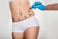 Surgeon Drawing Correction Lines On Woman`s Stomach