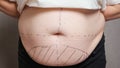 Surgeon draws correction marks on belly for plastic surgery Royalty Free Stock Photo