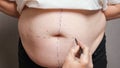 Surgeon draws correction marks on belly for plastic surgery Royalty Free Stock Photo