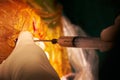 Surgeon hand drawing pus from brain abscess