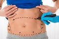 Surgeon Hands Drawing Correction Lines On Stomach