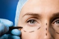 Surgeon preparing woman`s face for plastic surgery. facelift procedure