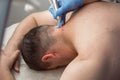 Surgeon is removing papillomas and moles using laser on man neck, burning skin.