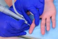 Surgeon operation removing wart on finger using laser beam, hands closeup.