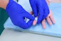 Surgeon seals finger of patient with plaster after removing wart, hands closeup.