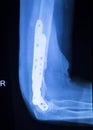 Surgical implant arm elbow xray test scan