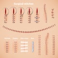 Surgical Stitches Infographic Set