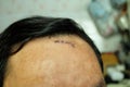 Suture sewn seven stitches on the head from accident, head injury