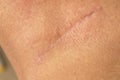Suture after surgery on the human neck. The scar after the surgery. Close up