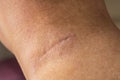 Suture after surgery on the human neck. The scar after the surgery. Close up