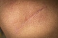 Suture after surgery on the human neck. The scar after the surgery. Close up