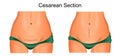 Sutures after cesarean section