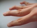 Swan neck deformity hypermobility