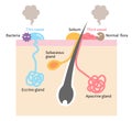 Sweating and body odor are caused by sweat glands in human body. Health care concept illustration for medical and health care use