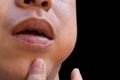 Swelling at the cheek of Asian man. Inflammation of parotid gland called parotitis. Mumps