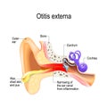 Swimmer`s ear. Otitis externa Royalty Free Stock Photo