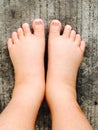 Swollen feet Royalty Free Stock Photo