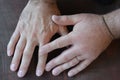 Swollen fist compared with healthy fist close up Royalty Free Stock Photo