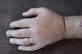 Swollen fist due to the sting of the wasp Royalty Free Stock Photo