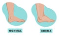 A swollen foot and ankle and a normal foot. Vector illustration