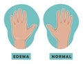 Swollen hand and normal hand. Edema and lymphedema. Vector illustration of the disease before-after.