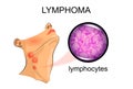 Swollen lymph nodes in lymphoma. Oncology