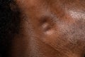 Swollen lymph nodes in the neck of an African man